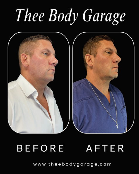 coolsculpting before adn after jawline chin