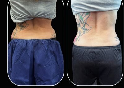 coolsculpting before and after 4.jpg