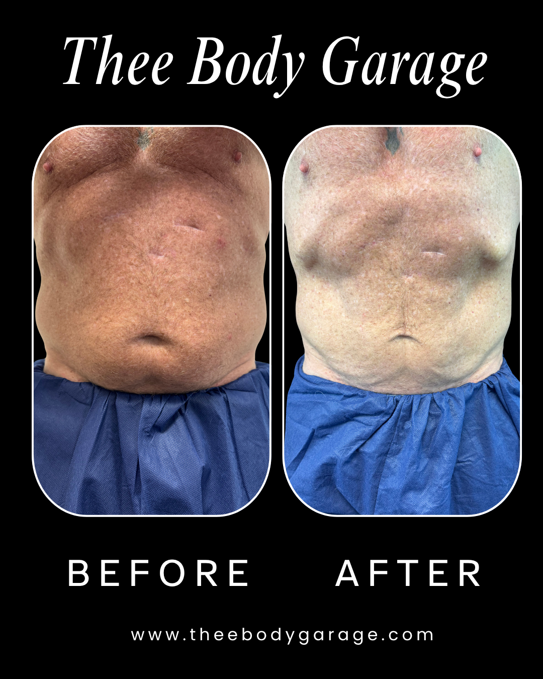 How Can I Lose My Stomach Fat?