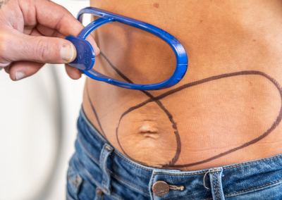 coolsculpting scottsdale 46