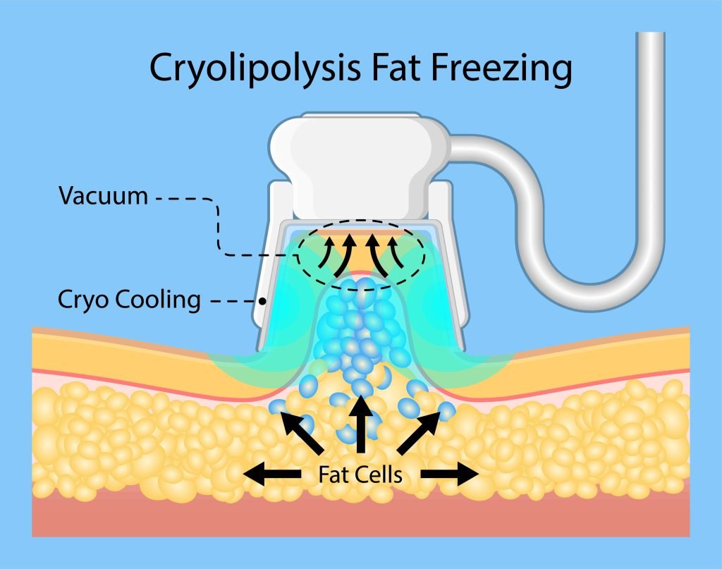 What is CoolSculpting®? 1 cryolipolysis near me fat freezing