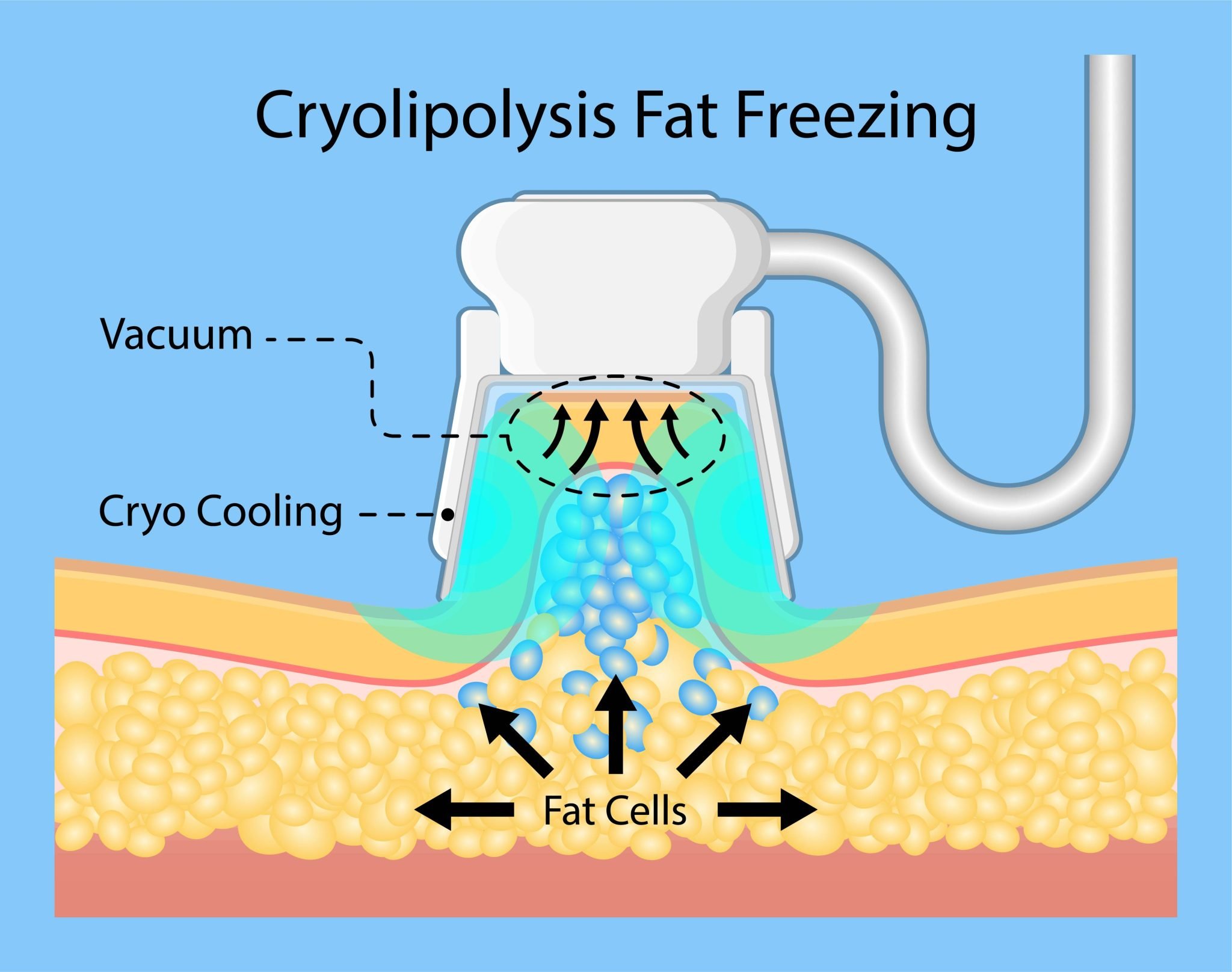 cryolipolysis fat freezing procedure cold treatment non invasive medication reduce temperature break down fat cells removal cosmetic surgery adipose liposuction Coolsculpting cryolipolysis near me fat freezing scaled