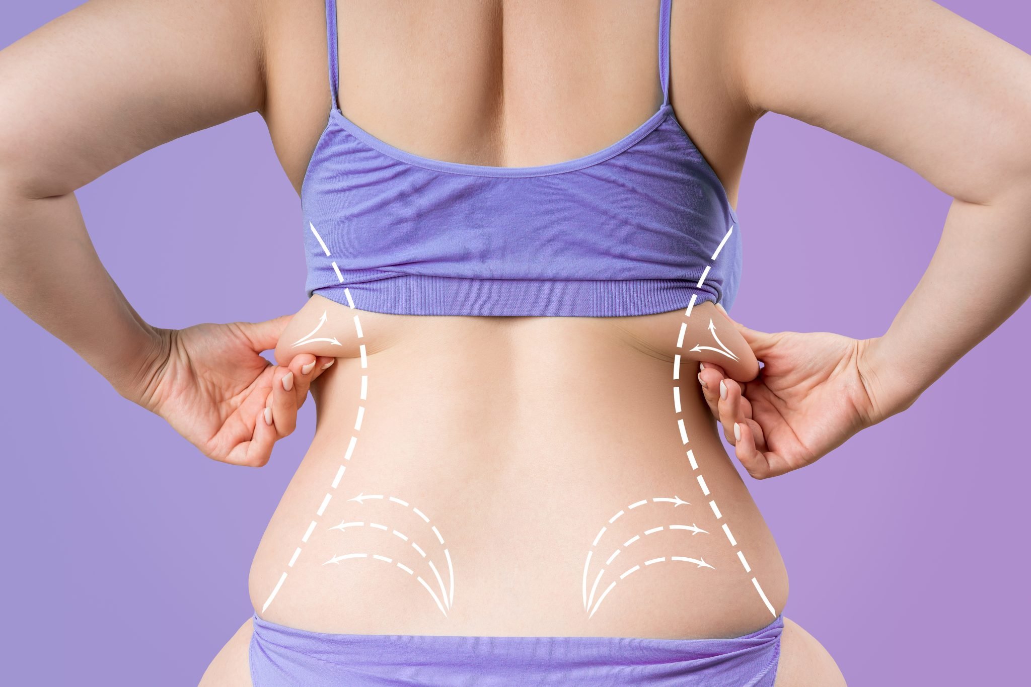 CoolSculpting Cost vs. Liposuction: What No One Tells You