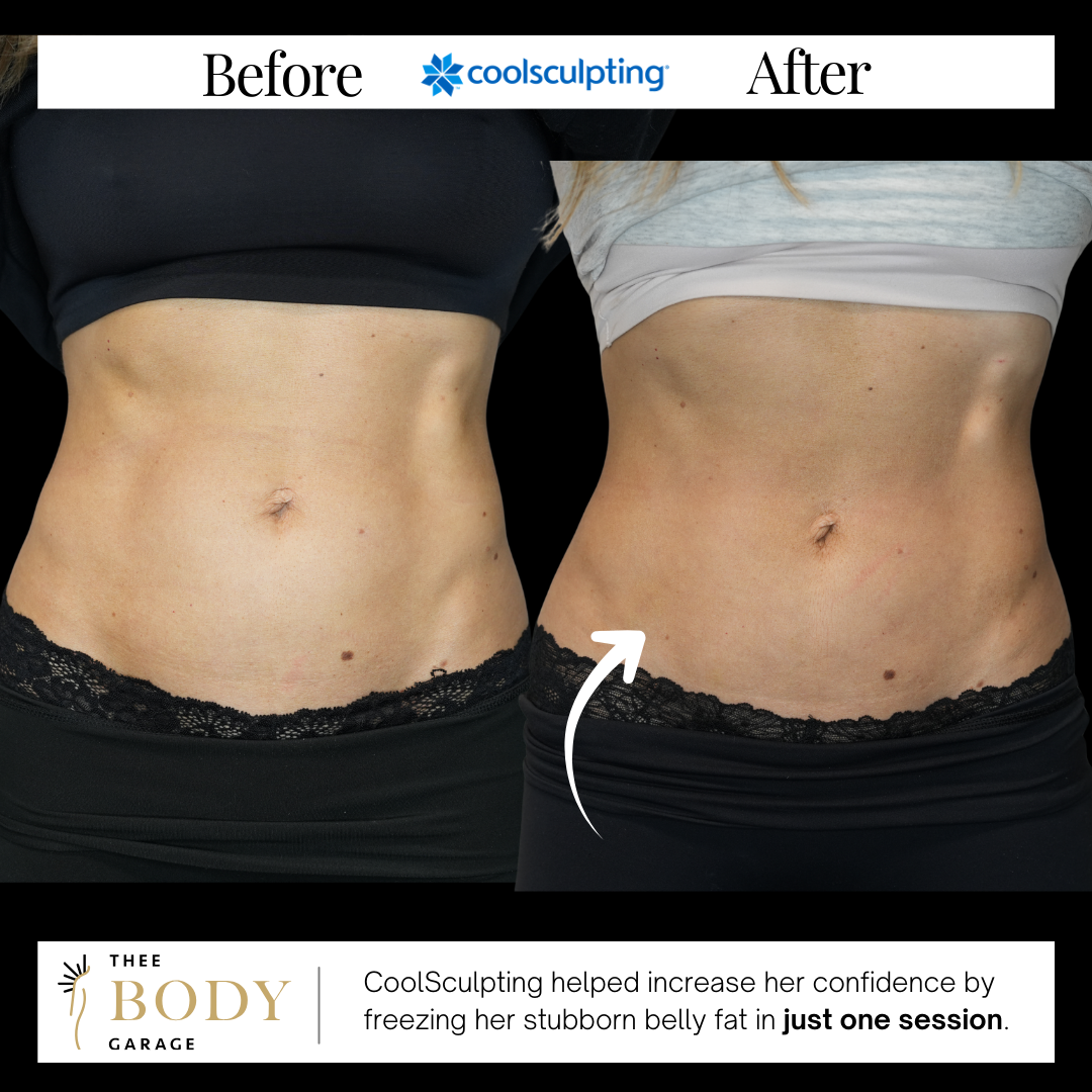 coolsculpting before and after stomach