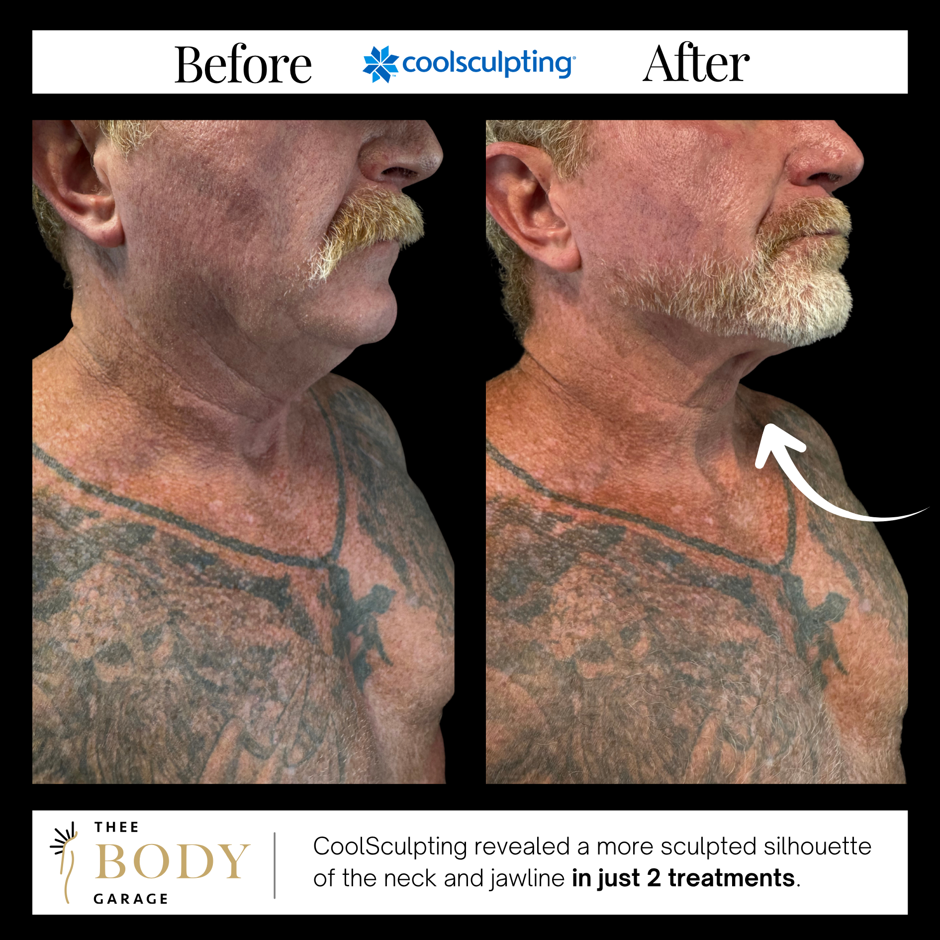 coolsculpting-before-and-after-jawline-results-1 copy coolsculpting before and after jawline results 1 copy