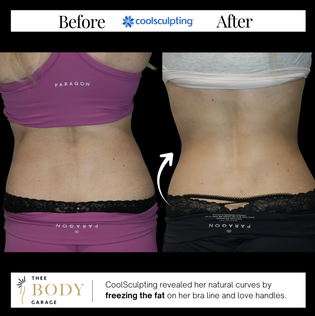 coolsculpting-before-and-after-love-handles-3-1019x1024 copy coolsculpting before and after love handles 3 1019x1024 copy