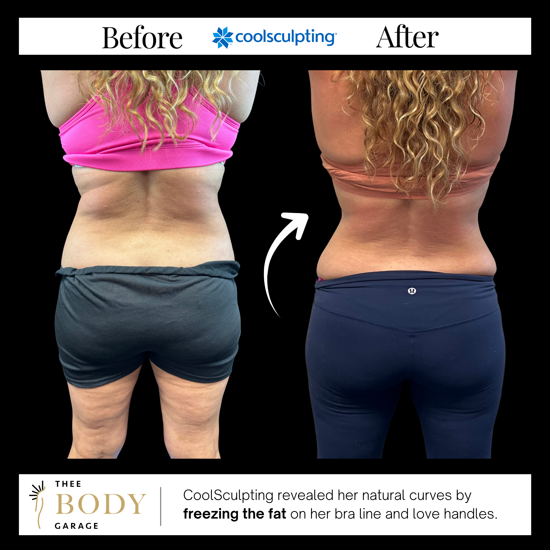 coolsculpting-before-and-after-love-handles-bra-results-4 copy coolsculpting before and after love handles bra results 4 copy
