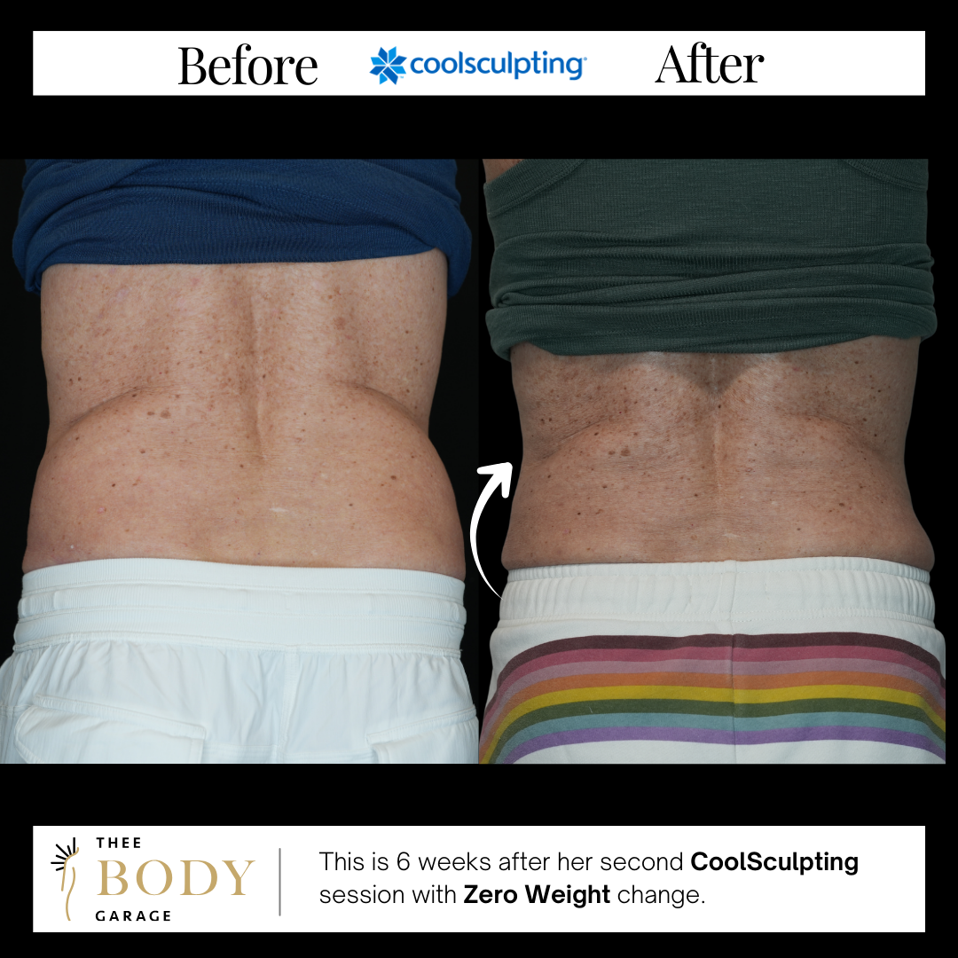 coolsculpting-before-and-after-love-handles copy coolsculpting before and after love handles copy