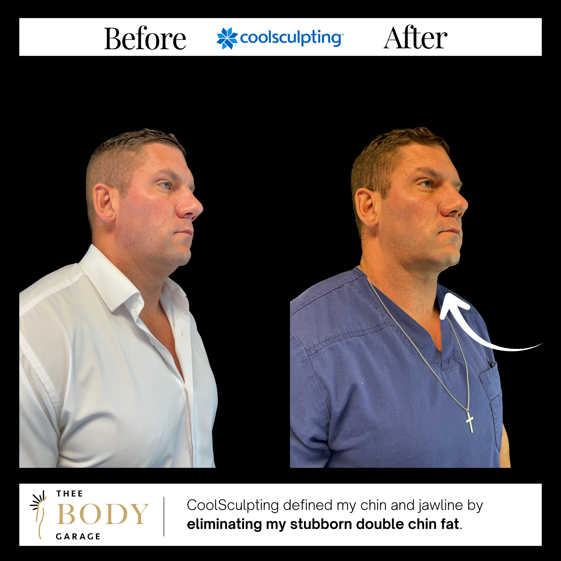 coolsculpting-before-and-after-results-3 copy coolsculpting before and after results 3 copy