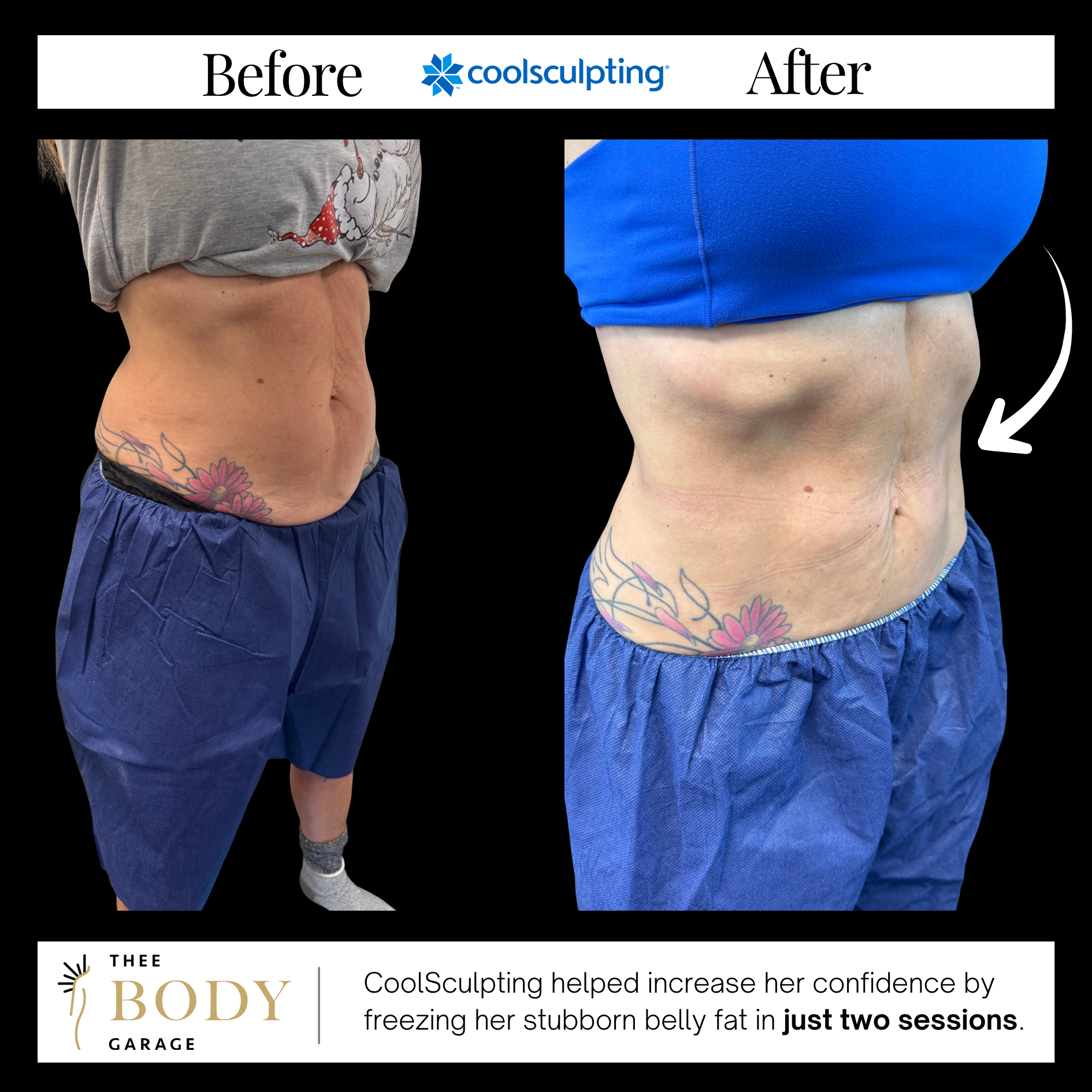 coolsculpting-before-and-after-results-5 copy coolsculpting before and after results 5 copy