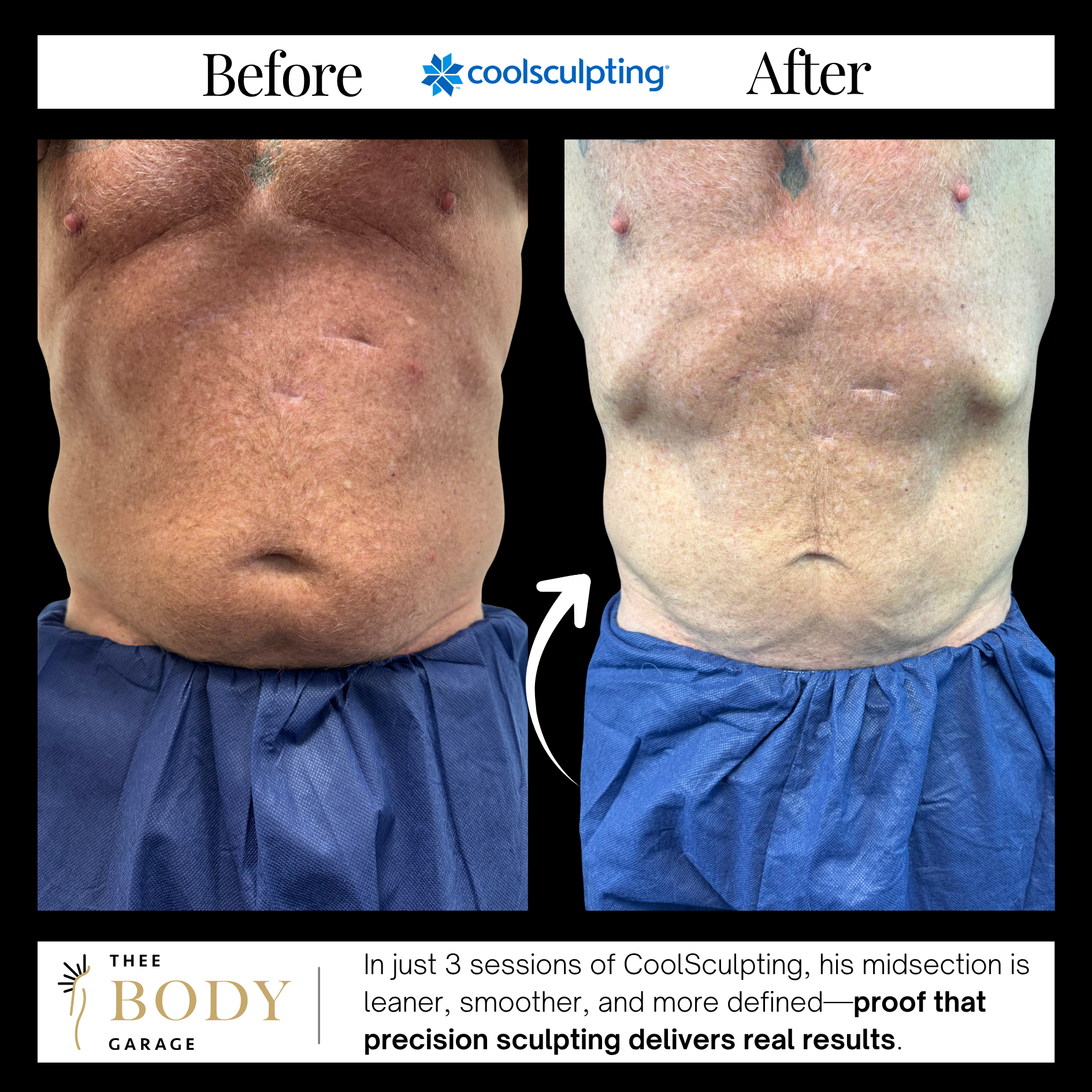 coolsculpting before and after results 7 copy