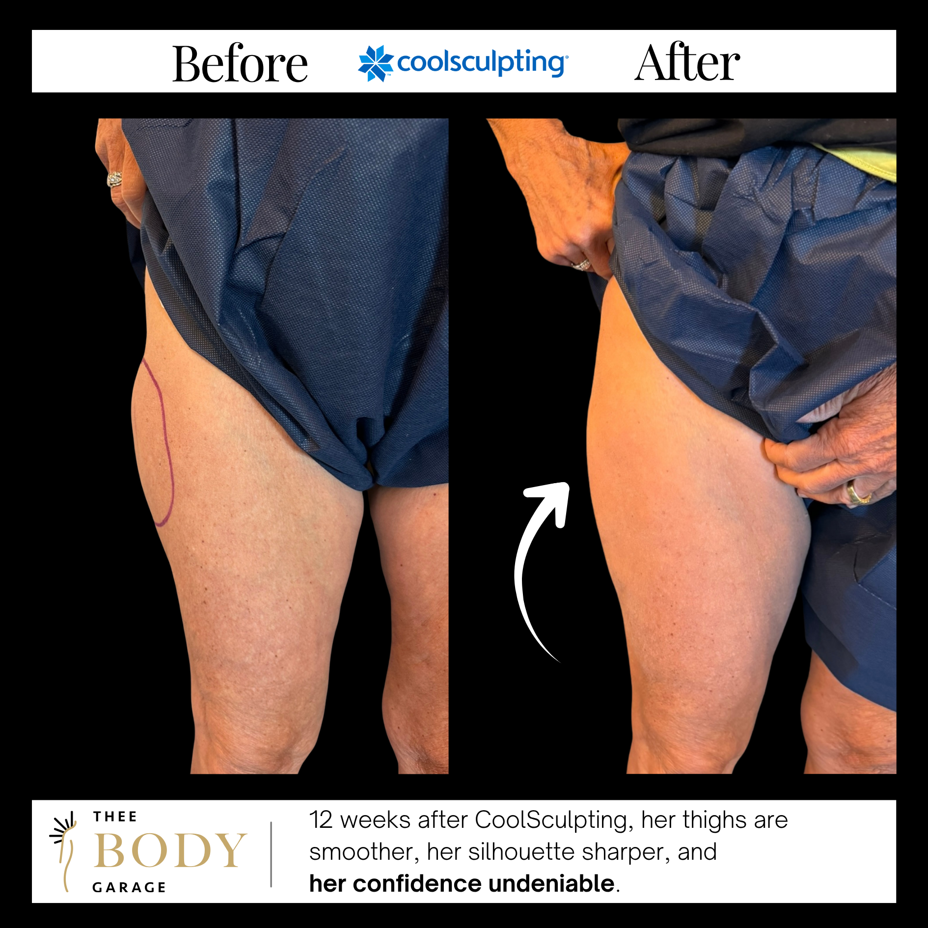 coolsculpting-before-and-after-thigh-saddle-bags-results-6 copy coolsculpting before and after thigh saddle bags results 6 copy