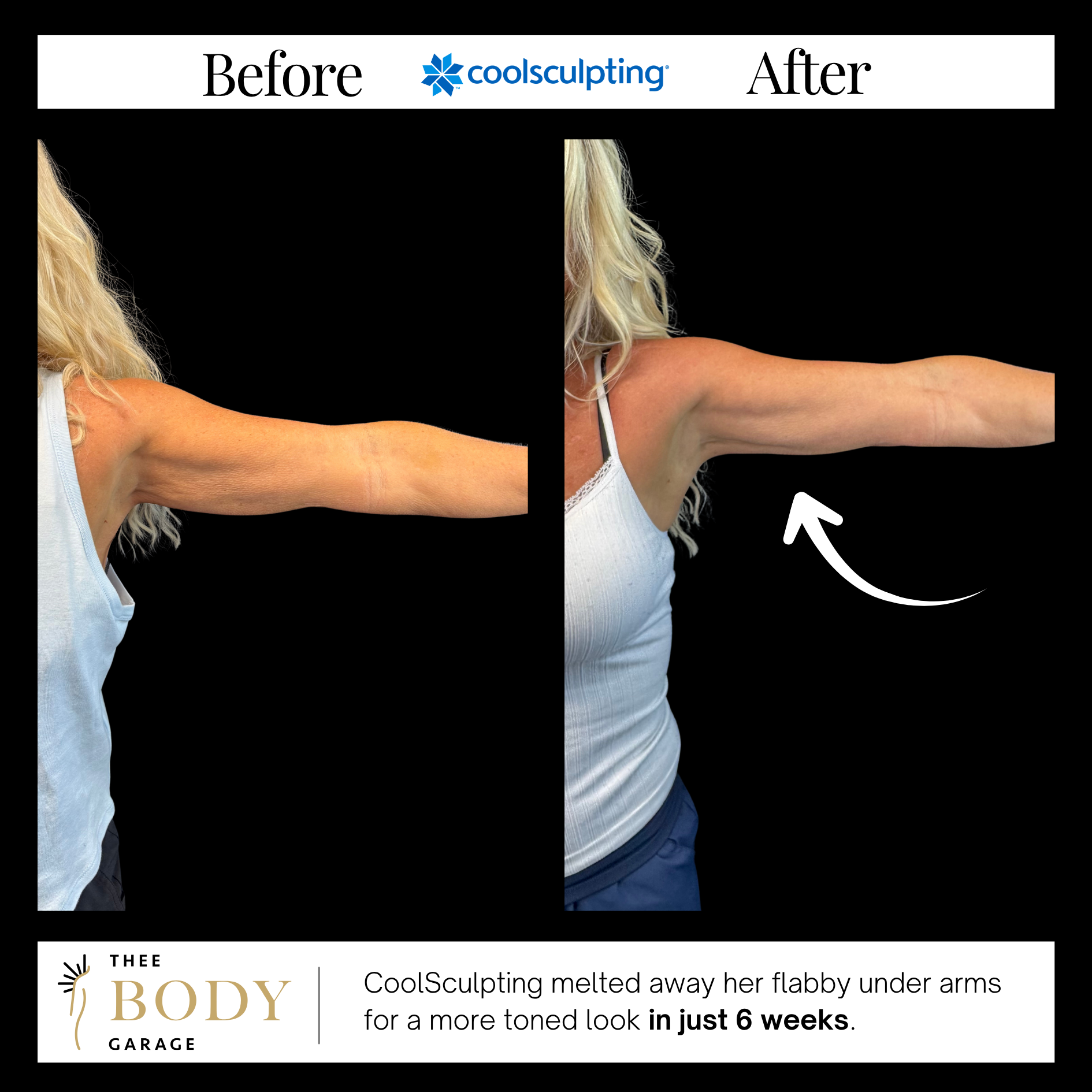 coolsculpting-before-and-after-under-arm-results-2 copy coolsculpting before and after under arm results 2 copy