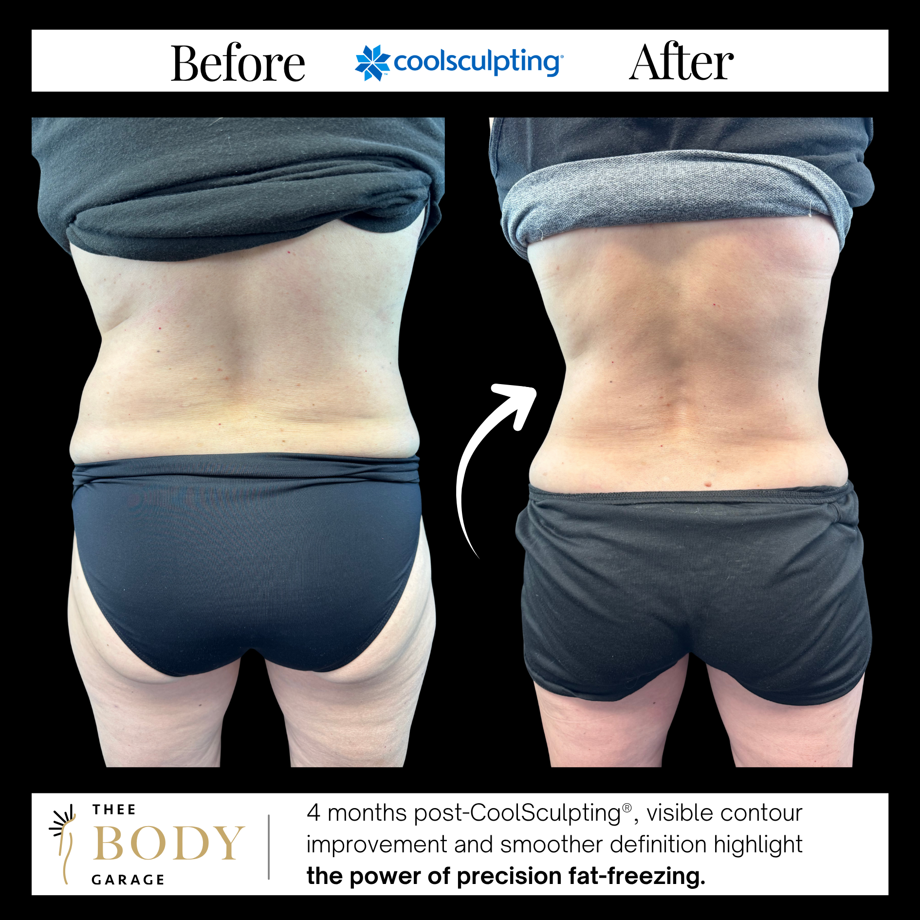 coolsculpting before and after waist love handles results 9 copy
