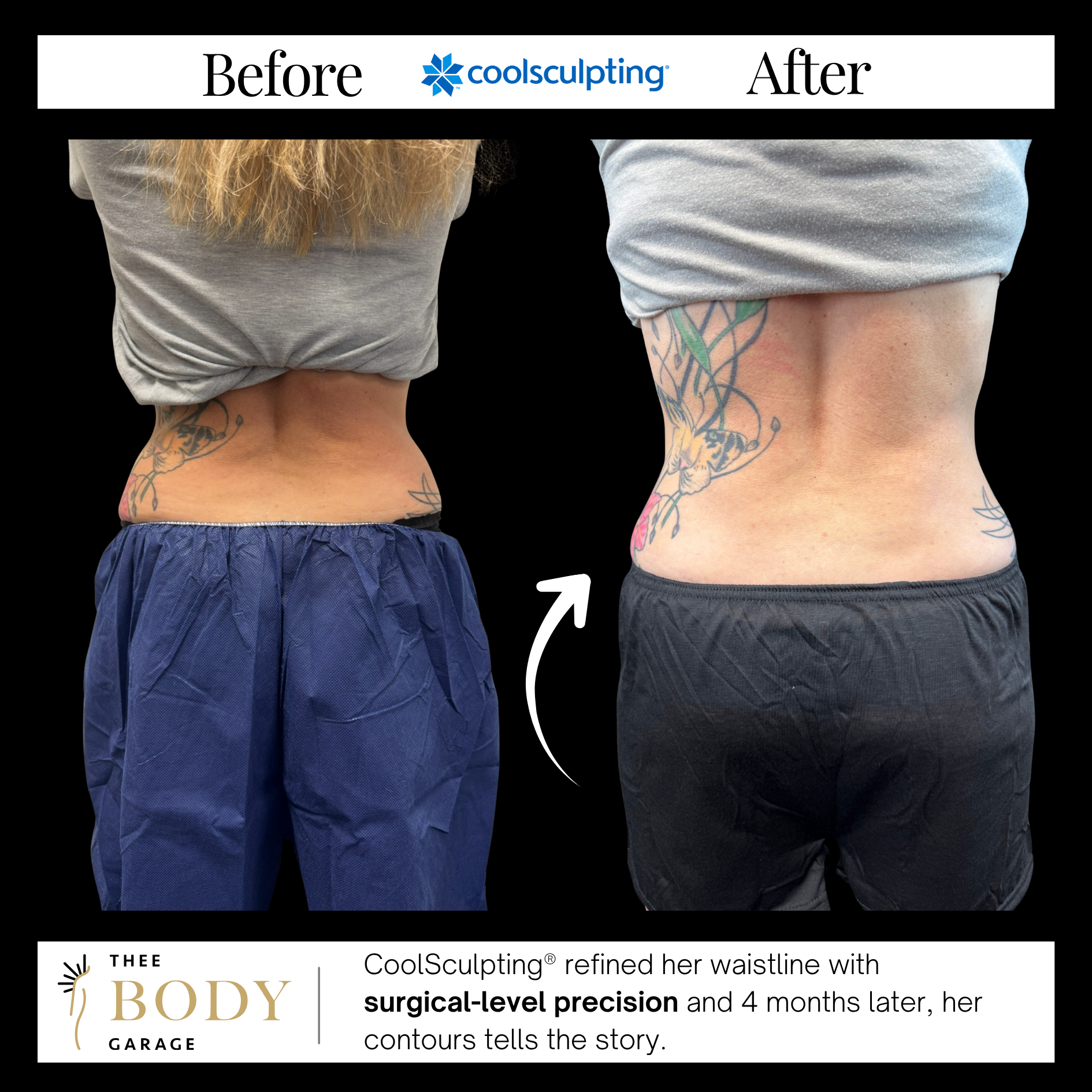 coolsculpting-before-and-after-waistresults-8 copy coolsculpting before and after waistresults 8 copy